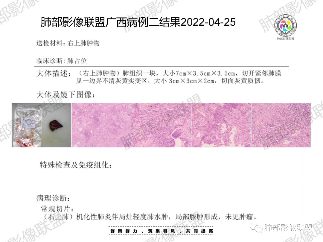 影像PPT - 【病例】胸椎旁病变伴骨破坏,肺内还是肺外?恶性还是良性?-39 影像PPT - 【病例】胸椎旁病变伴骨破坏,肺内还是肺外?恶性还是良性?-39