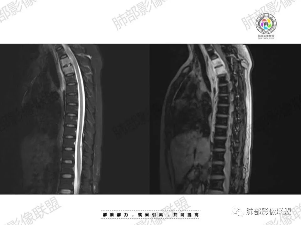 影像PPT - 【病例】胸椎旁病变伴骨破坏,肺内还是肺外?恶性还是良性?-35 影像PPT - 【病例】胸椎旁病变伴骨破坏,肺内还是肺外?恶性还是良性?-35