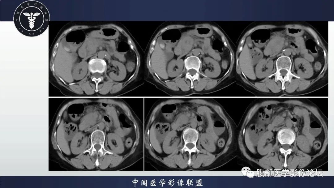影像PPT - 【病例】肿块型胰腺炎1例CT影像诊断-6