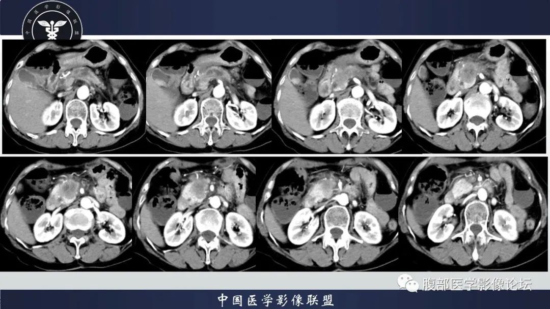 影像PPT - 【病例】肿块型胰腺炎1例CT影像诊断-7