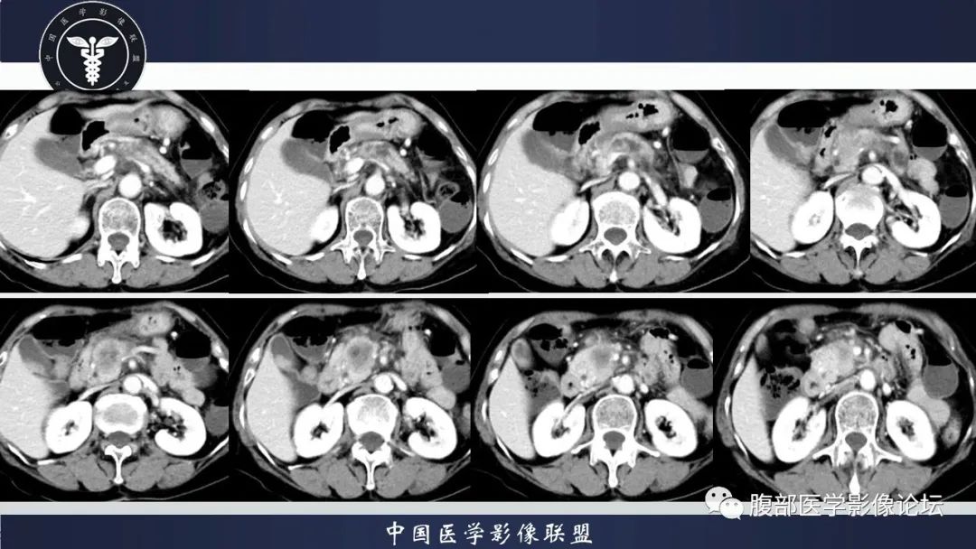 影像PPT - 【病例】肿块型胰腺炎1例CT影像诊断-8