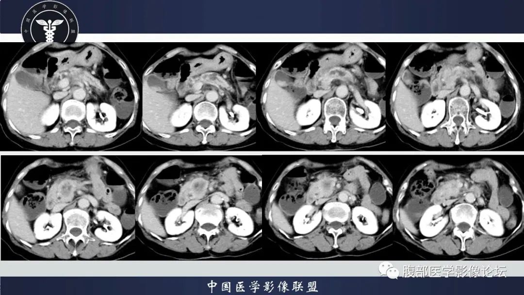 影像PPT - 【病例】肿块型胰腺炎1例CT影像诊断-9