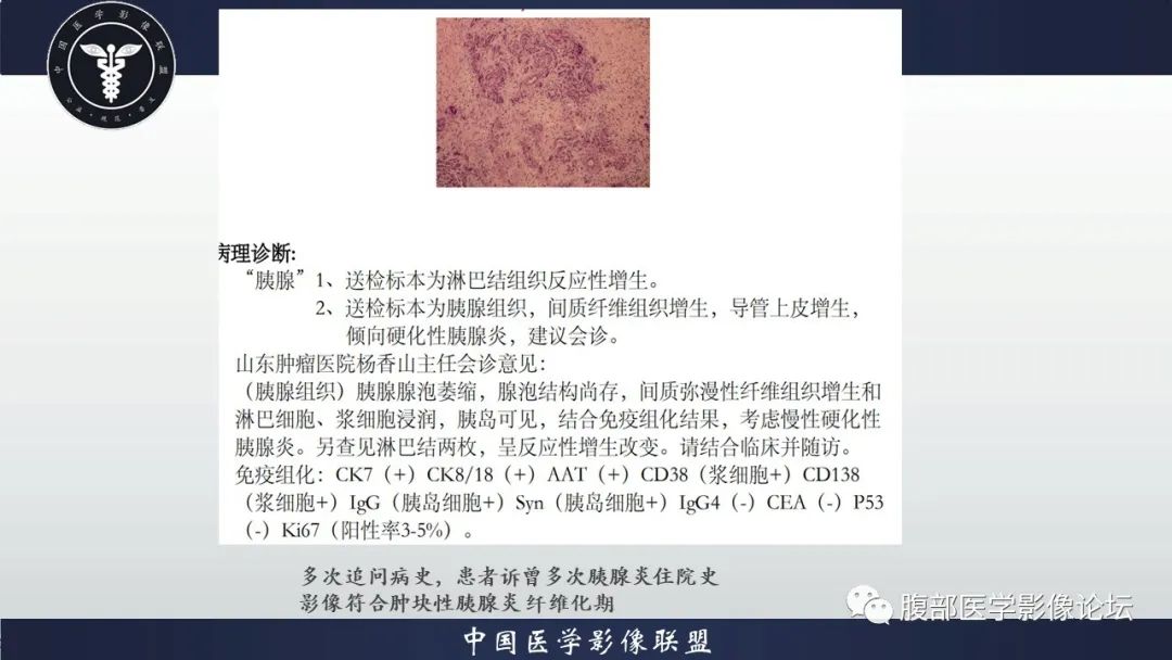 影像PPT - 【病例】肿块型胰腺炎1例CT影像诊断-10