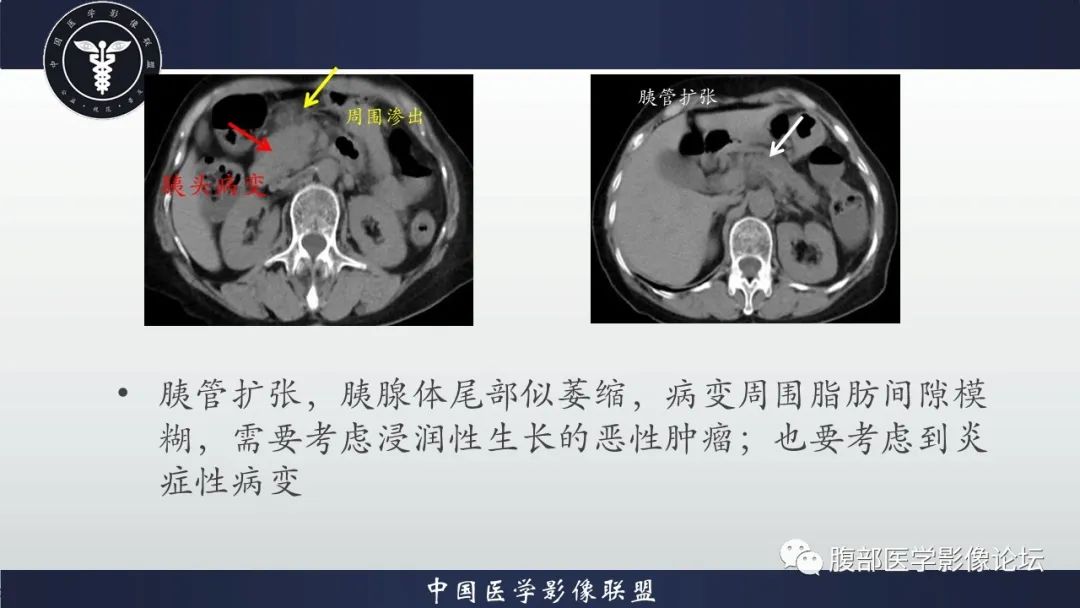 影像PPT - 【病例】肿块型胰腺炎1例CT影像诊断-11