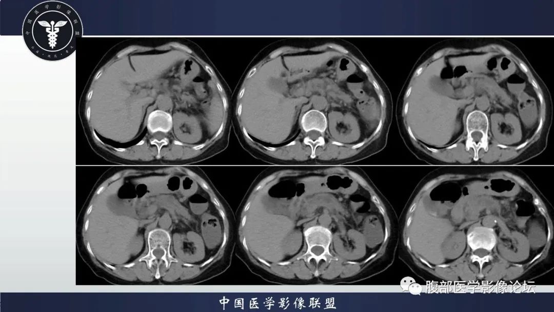 影像PPT - 【病例】肿块型胰腺炎1例CT影像诊断-5