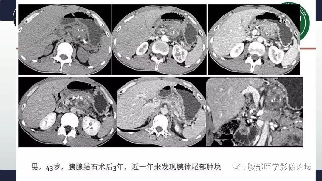 影像PPT - 【病例】肿块型胰腺炎1例CT影像诊断-18