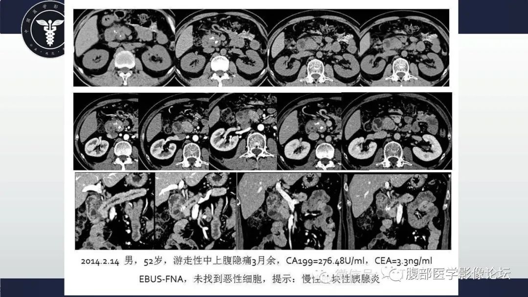 影像PPT - 【病例】肿块型胰腺炎1例CT影像诊断-19
