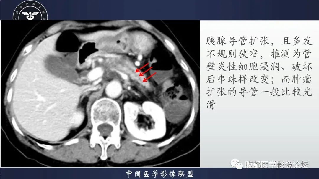 影像PPT - 【病例】肿块型胰腺炎1例CT影像诊断-13