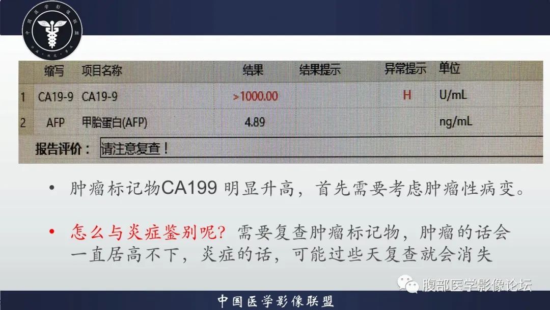 影像PPT - 【病例】肿块型胰腺炎1例CT影像诊断-14