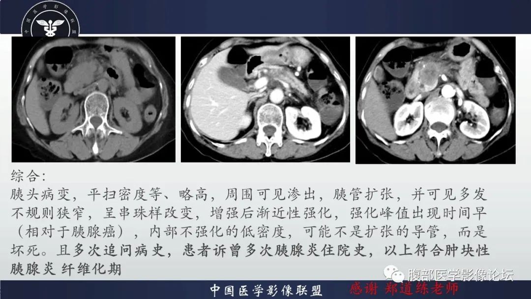影像PPT - 【病例】肿块型胰腺炎1例CT影像诊断-15