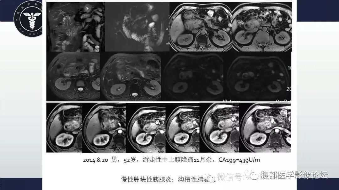 影像PPT - 【病例】肿块型胰腺炎1例CT影像诊断-20
