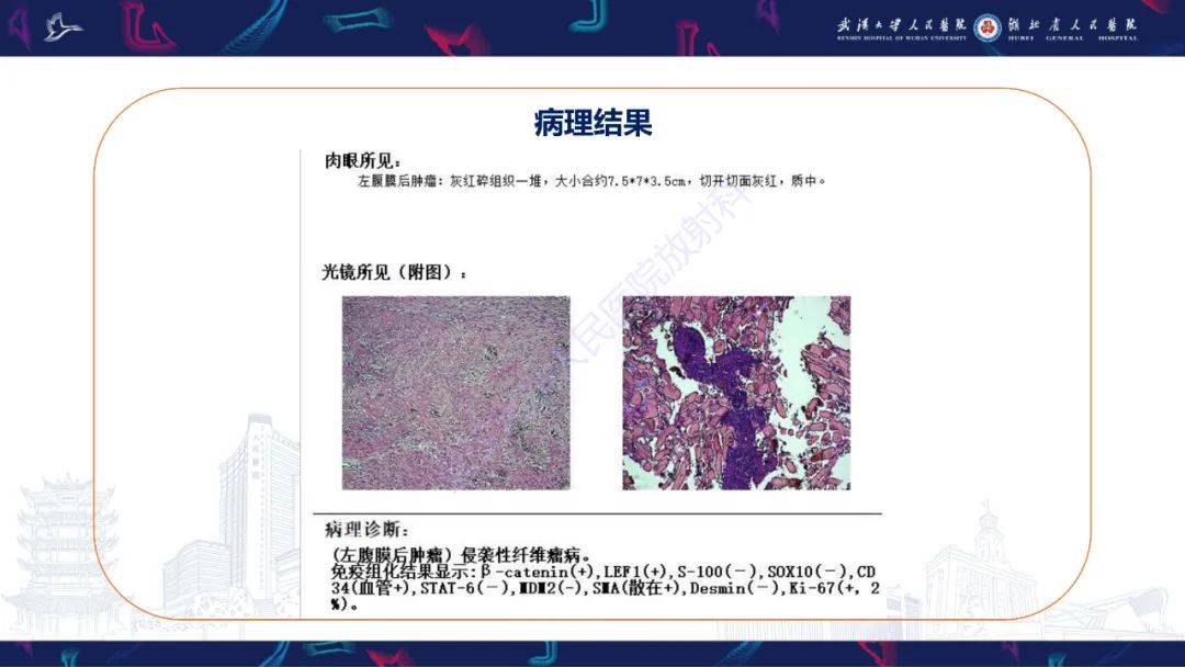 影像PPT - 【PPT】腹膜后腰大肌区侵袭性纤维瘤病影像诊断-4