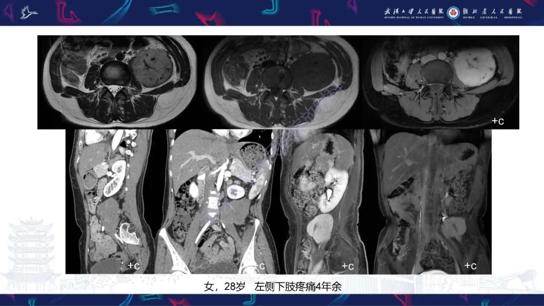 影像PPT - 【PPT】腹膜后腰大肌区侵袭性纤维瘤病影像诊断-2