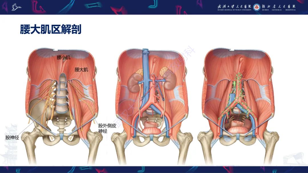 影像PPT - 【PPT】腹膜后腰大肌区侵袭性纤维瘤病影像诊断-6