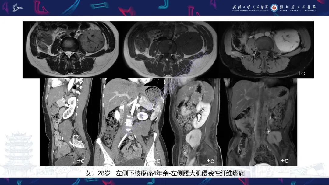 影像PPT - 【PPT】腹膜后腰大肌区侵袭性纤维瘤病影像诊断-9