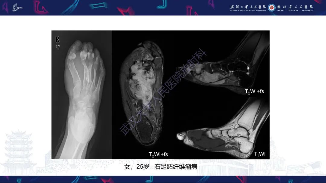 影像PPT - 【PPT】腹膜后腰大肌区侵袭性纤维瘤病影像诊断-11