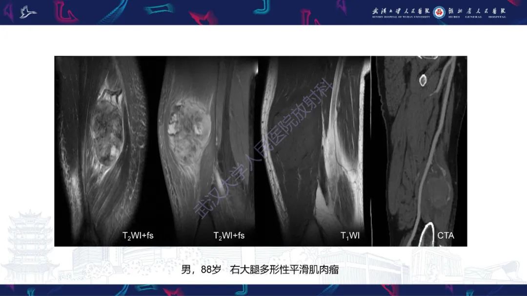 影像PPT - 【PPT】腹膜后腰大肌区侵袭性纤维瘤病影像诊断-15