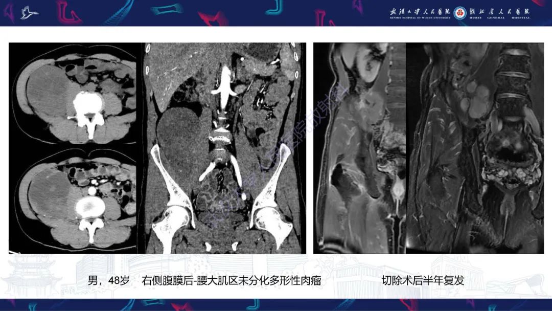 影像PPT - 【PPT】腹膜后腰大肌区侵袭性纤维瘤病影像诊断-17