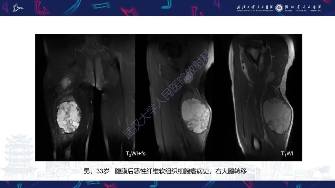 影像PPT - 【PPT】腹膜后腰大肌区侵袭性纤维瘤病影像诊断-18
