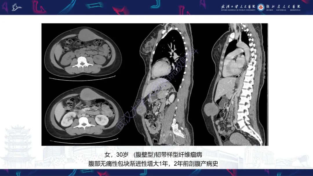 影像PPT - 【PPT】腹膜后腰大肌区侵袭性纤维瘤病影像诊断-10