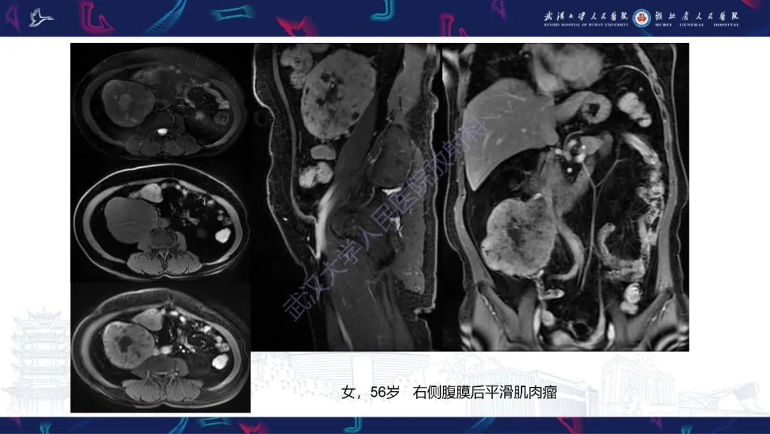 影像PPT - 【PPT】腹膜后腰大肌区侵袭性纤维瘤病影像诊断-14