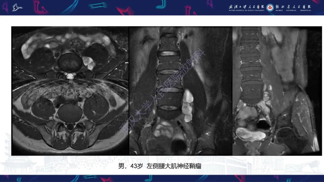 影像PPT - 【PPT】腹膜后腰大肌区侵袭性纤维瘤病影像诊断-24
