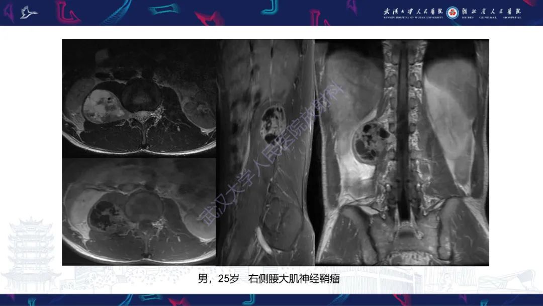 影像PPT - 【PPT】腹膜后腰大肌区侵袭性纤维瘤病影像诊断-25