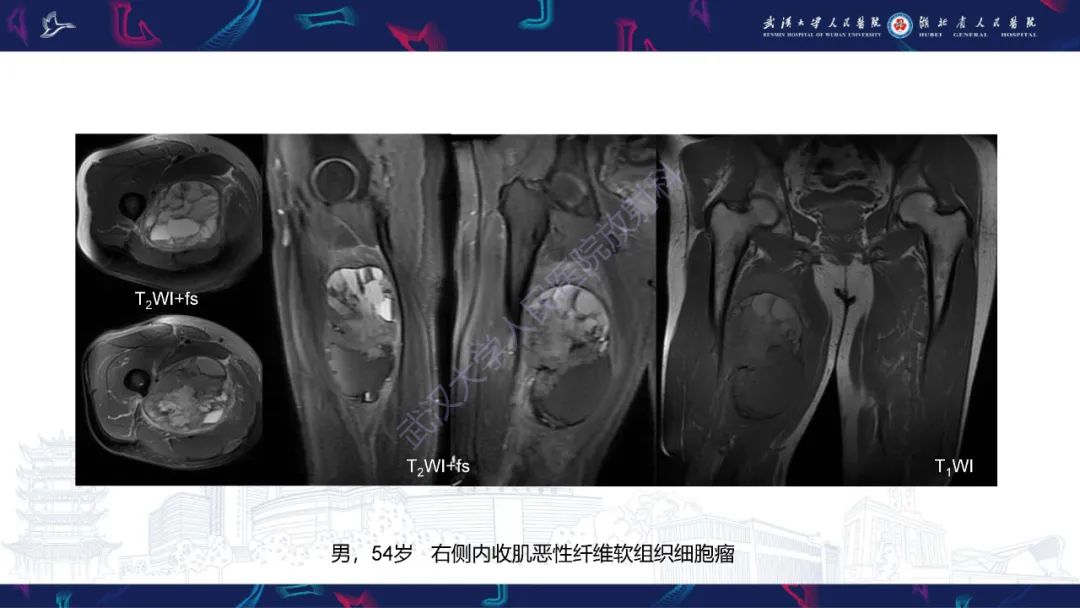 影像PPT - 【PPT】腹膜后腰大肌区侵袭性纤维瘤病影像诊断-19
