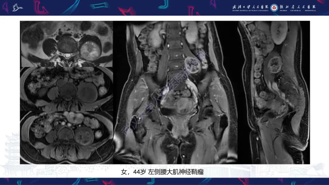 影像PPT - 【PPT】腹膜后腰大肌区侵袭性纤维瘤病影像诊断-22