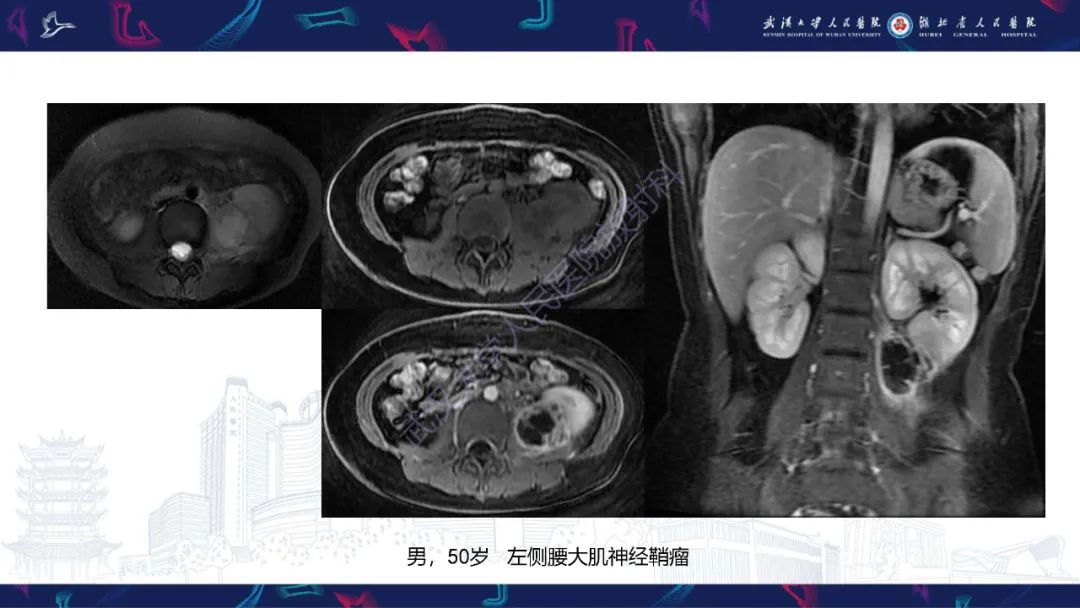 影像PPT - 【PPT】腹膜后腰大肌区侵袭性纤维瘤病影像诊断-23