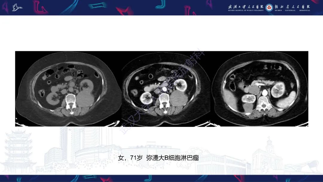 影像PPT - 【PPT】腹膜后腰大肌区侵袭性纤维瘤病影像诊断-29
