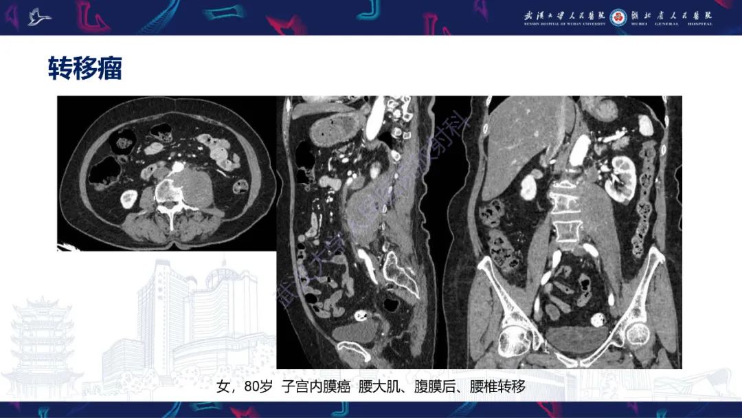 影像PPT - 【PPT】腹膜后腰大肌区侵袭性纤维瘤病影像诊断-31