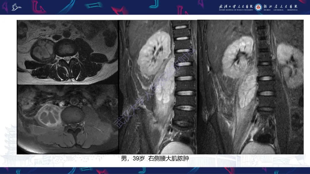 影像PPT - 【PPT】腹膜后腰大肌区侵袭性纤维瘤病影像诊断-26