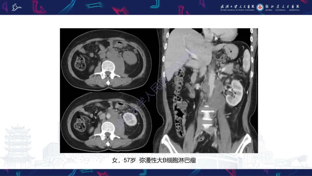 影像PPT - 【PPT】腹膜后腰大肌区侵袭性纤维瘤病影像诊断-28