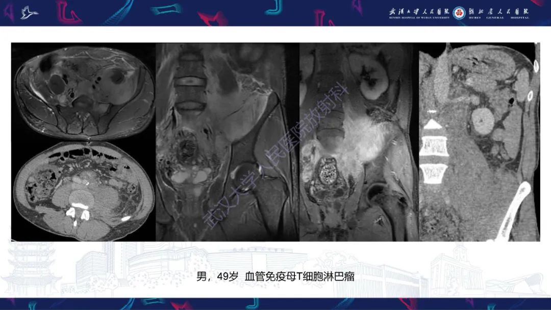 影像PPT - 【PPT】腹膜后腰大肌区侵袭性纤维瘤病影像诊断-30