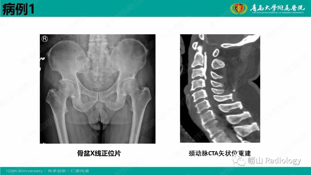 影像PPT - 【病例】弥漫性特发性骨肥厚症 VS 强直性脊柱炎-7