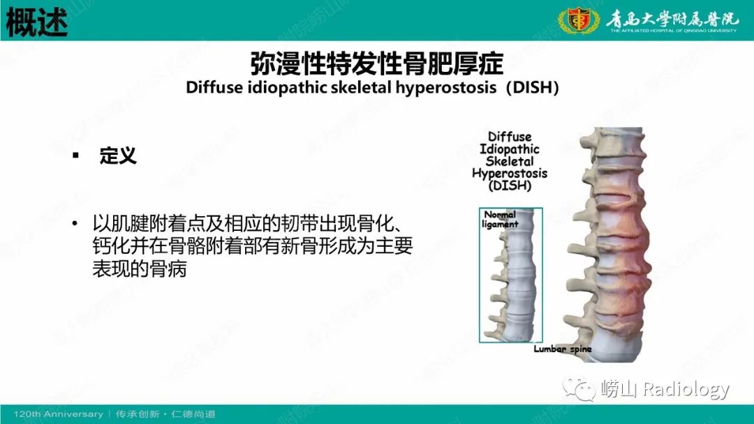 影像PPT - 【病例】弥漫性特发性骨肥厚症 VS 强直性脊柱炎-9