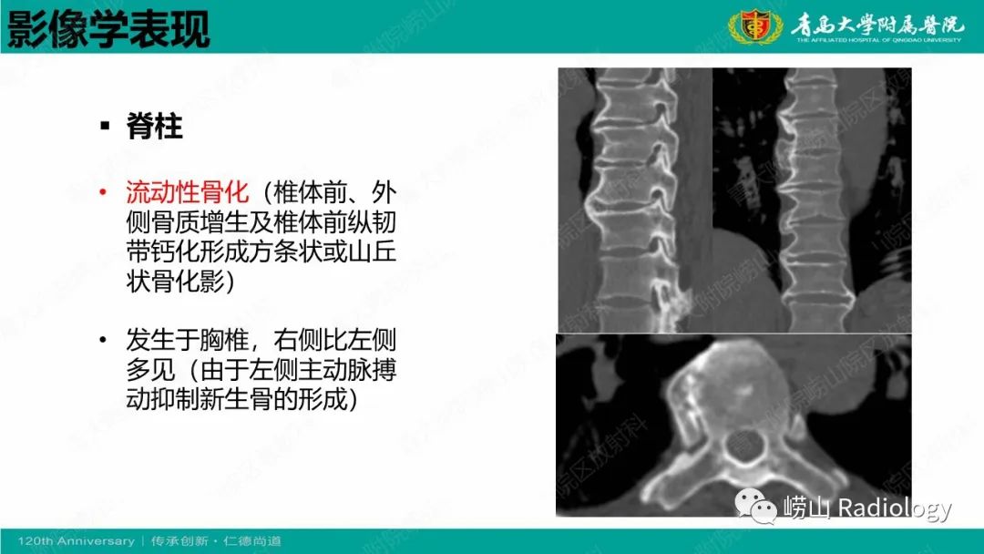 影像PPT - 【病例】弥漫性特发性骨肥厚症 VS 强直性脊柱炎-14