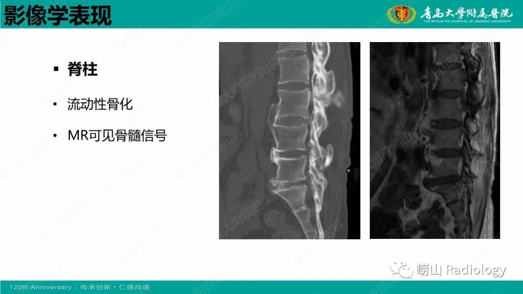 影像PPT - 【病例】弥漫性特发性骨肥厚症 VS 强直性脊柱炎-15