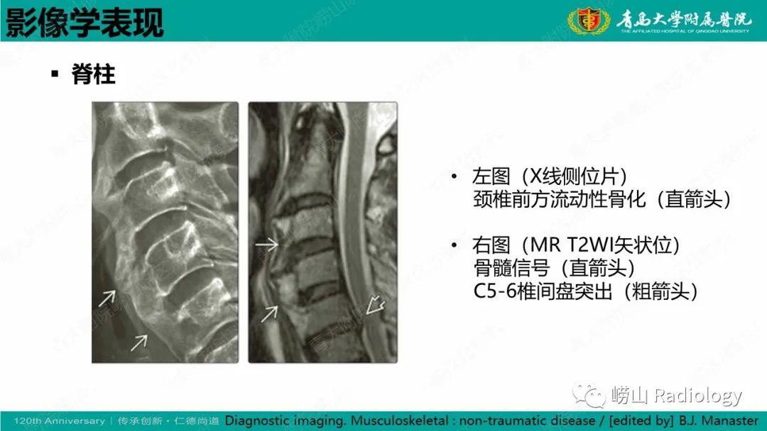 影像PPT - 【病例】弥漫性特发性骨肥厚症 VS 强直性脊柱炎-17