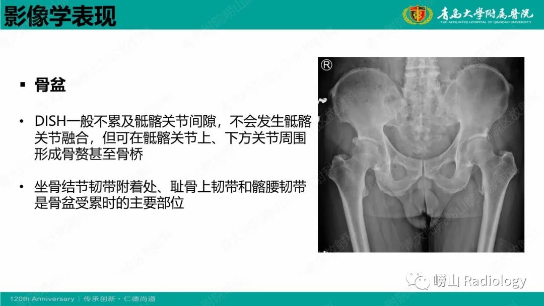 影像PPT - 【病例】弥漫性特发性骨肥厚症 VS 强直性脊柱炎-18