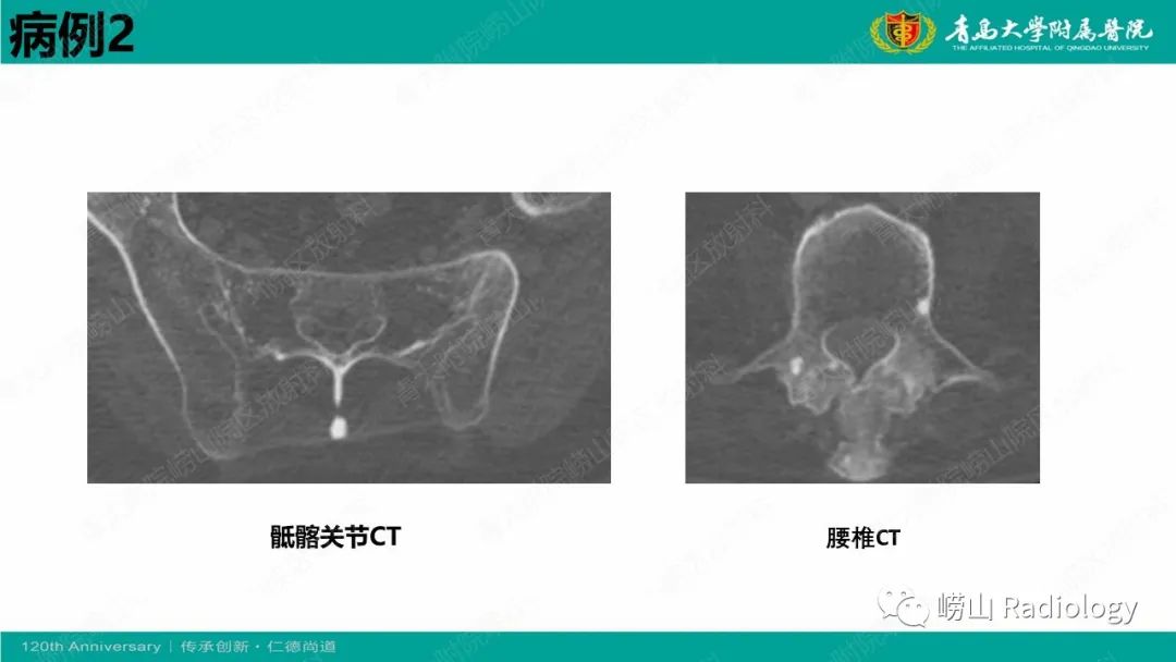 影像PPT - 【病例】弥漫性特发性骨肥厚症 VS 强直性脊柱炎-20