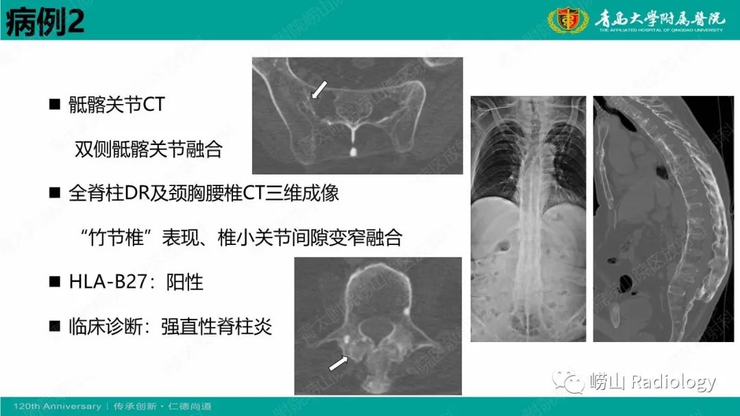 影像PPT - 【病例】弥漫性特发性骨肥厚症 VS 强直性脊柱炎-21
