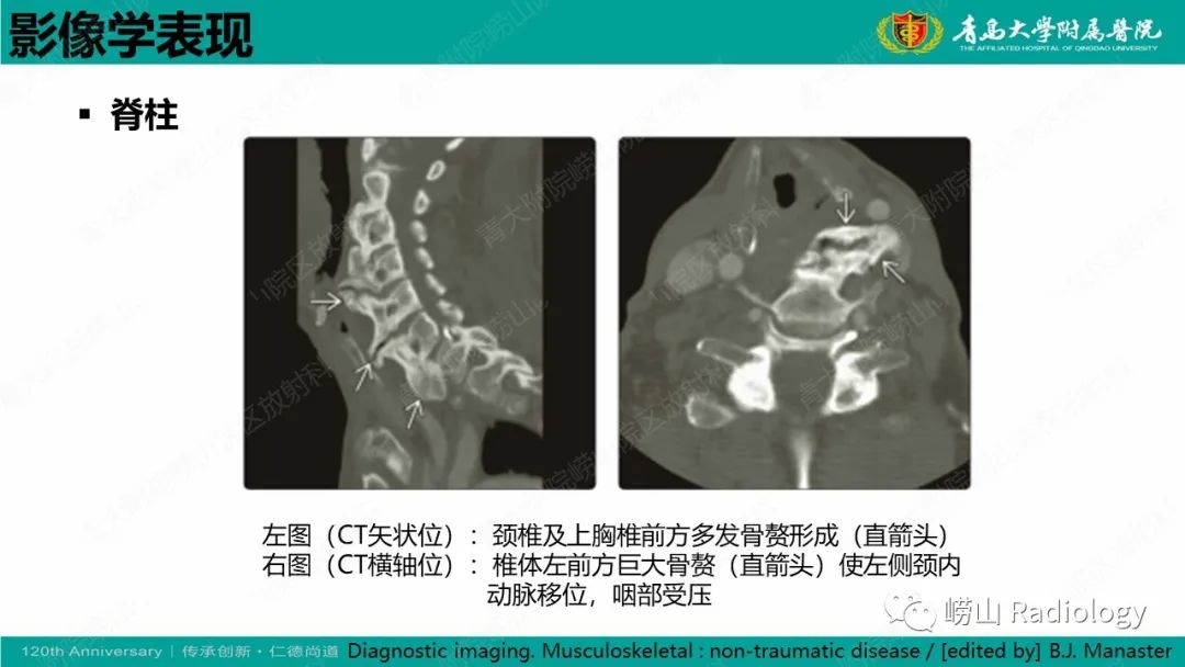 影像PPT - 【病例】弥漫性特发性骨肥厚症 VS 强直性脊柱炎-16