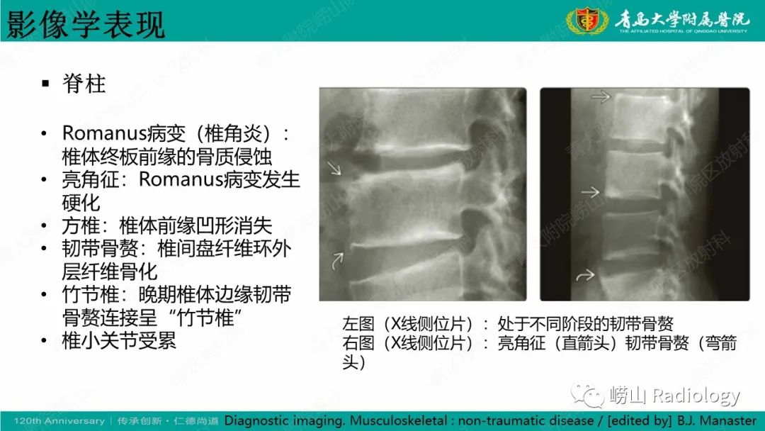 影像PPT - 【病例】弥漫性特发性骨肥厚症 VS 强直性脊柱炎-24