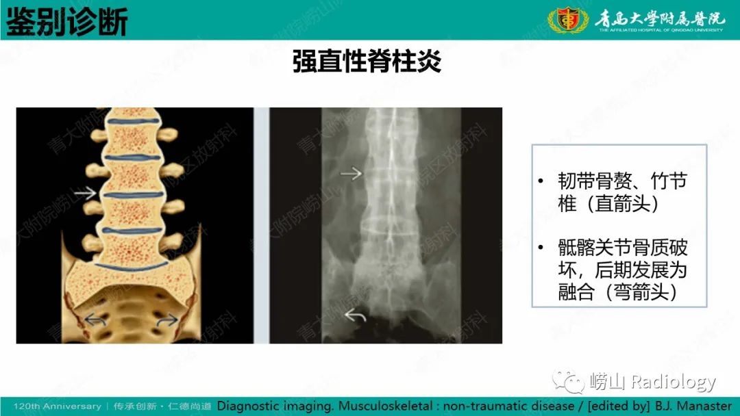影像PPT - 【病例】弥漫性特发性骨肥厚症 VS 强直性脊柱炎-25