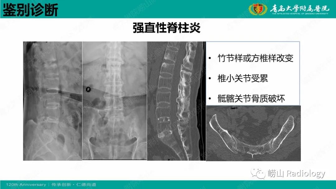 影像PPT - 【病例】弥漫性特发性骨肥厚症 VS 强直性脊柱炎-26