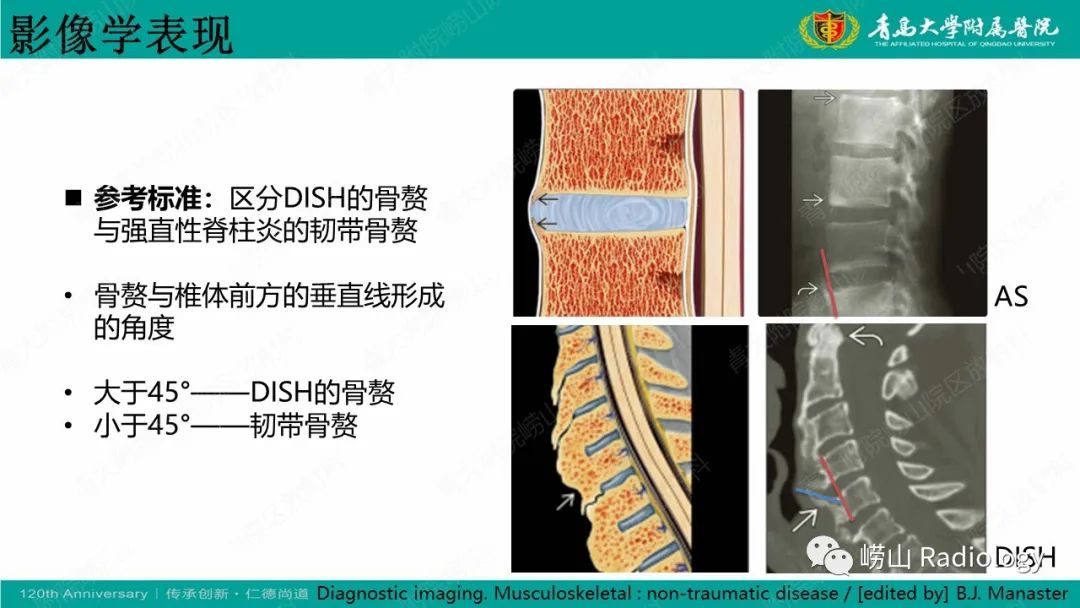 影像PPT - 【病例】弥漫性特发性骨肥厚症 VS 强直性脊柱炎-27