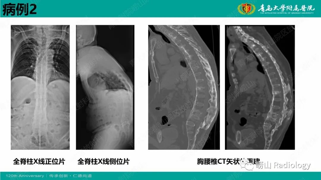 影像PPT - 【病例】弥漫性特发性骨肥厚症 VS 强直性脊柱炎-19