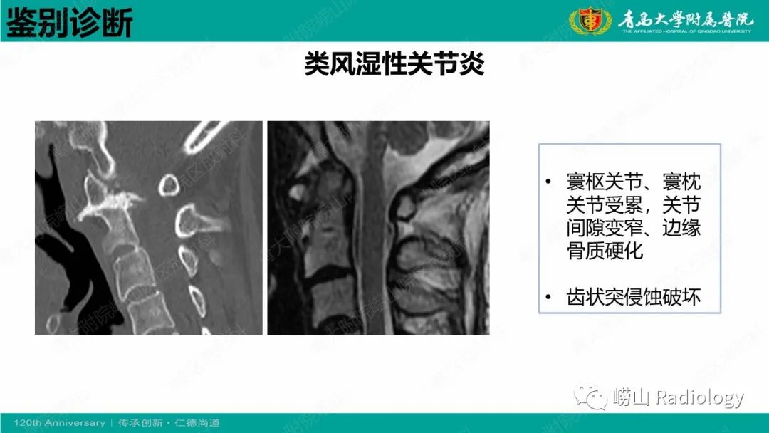 影像PPT - 【病例】弥漫性特发性骨肥厚症 VS 强直性脊柱炎-32